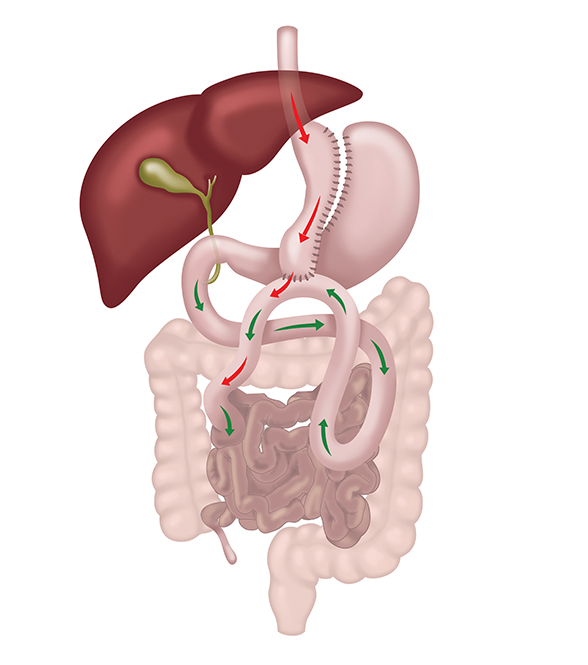 One Anastomosis Gastric Bypass diagram showing the small stomach pouch joined to the small intestine