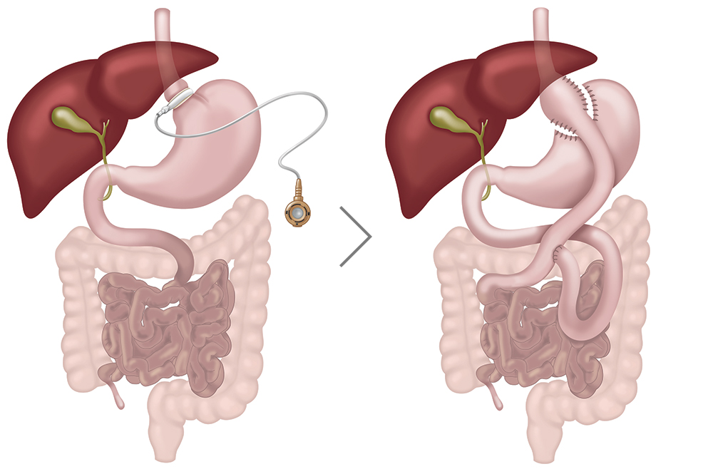 Revisional surgery